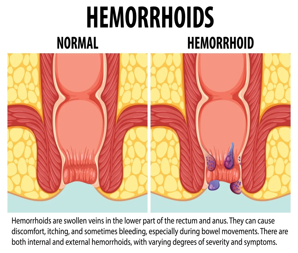 relieves hemorrhoids-  Healthi Vibes (image by Freepik)