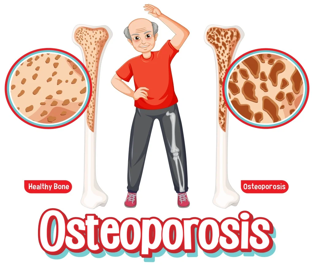 Osteoporosis Prevention- - Healthi Vibes (image by Freepik)